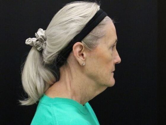 Face & Neck Lifts: Case 54 - Before