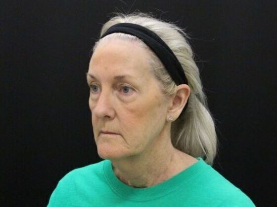 Face & Neck Lifts: Case 54 - Before