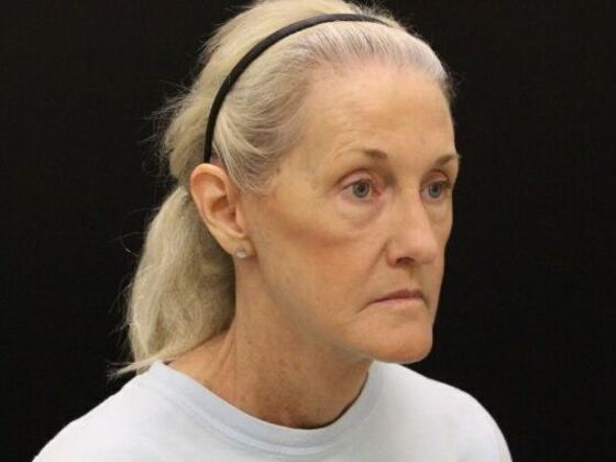 Face & Neck Lifts: Case 54 - After