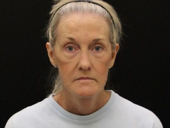 Face & Neck Lifts Case 54 - After