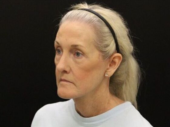 Face & Neck Lifts: Case 54 - After