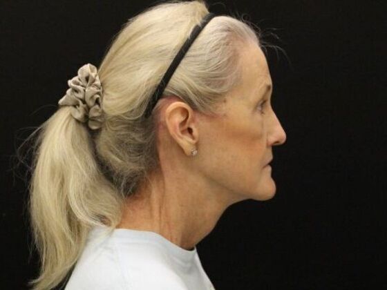Face & Neck Lifts: Case 54 - After