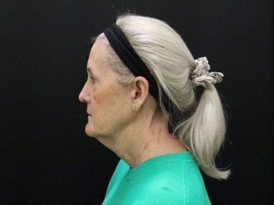 Face & Neck Lifts: Case 54 - Before