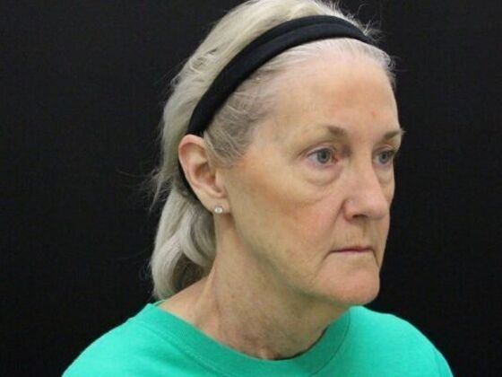 Face & Neck Lifts: Case 54 - Before