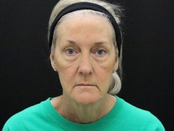 Face & Neck Lifts Case 54 - Before