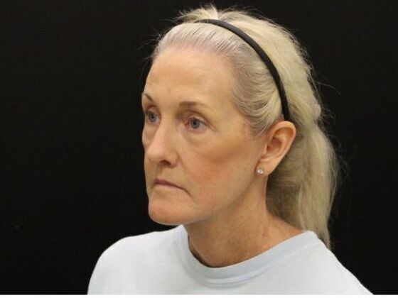 Eyelid Surgery: Case 21 - After