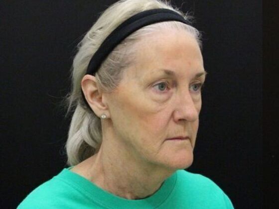 Eyelid Surgery: Case 21 - Before