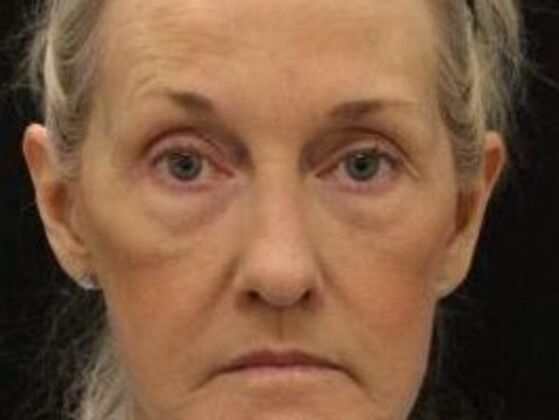 Eyelid Surgery Case 21 - After