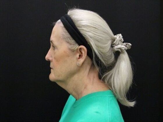 Eyelid Surgery: Case 21 - Before