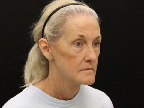 Eyelid Surgery: Case 21 - After