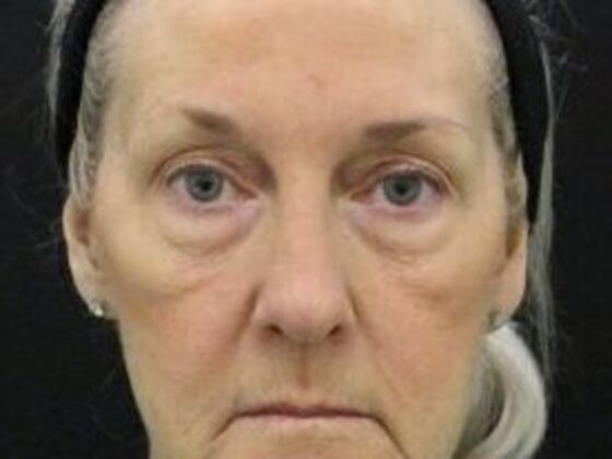 Eyelid Surgery Case 21 - Before