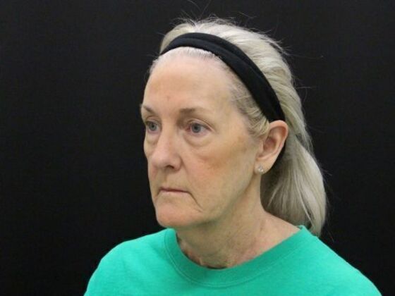 Non-Surgical: Case 15 - Before