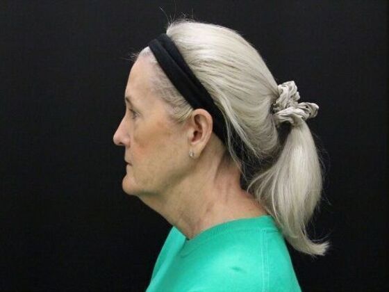 Non-Surgical: Case 15 - Before