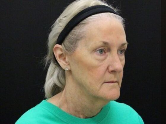 Non-Surgical: Case 15 - Before