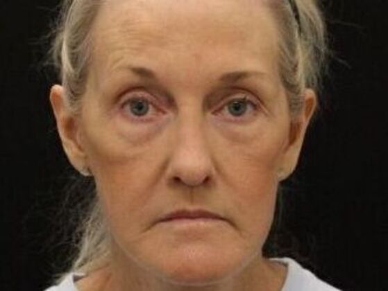 Non-Surgical: Case 15 - After