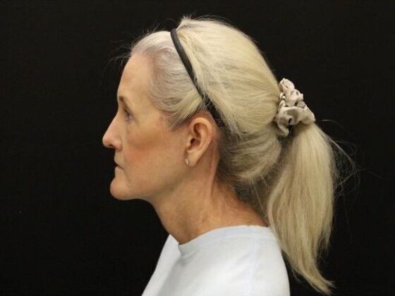 Non-Surgical: Case 15 - After