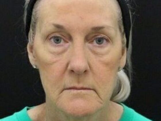 Non-Surgical: Case 15 - Before