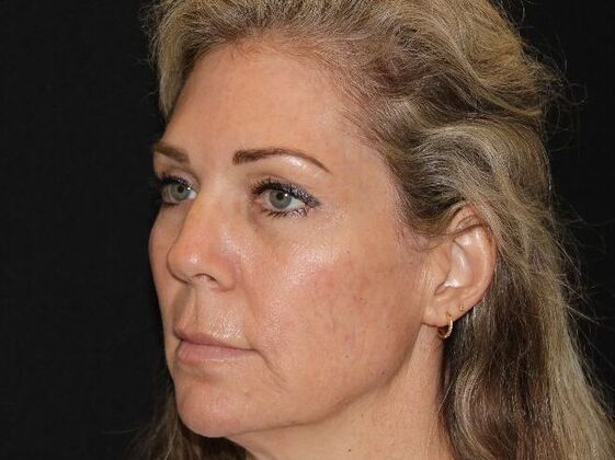 Injectables: Case 91 - Before