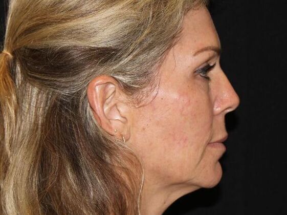 Injectables: Case 91 - Before