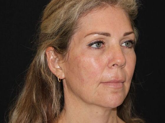 Injectables: Case 91 - Before