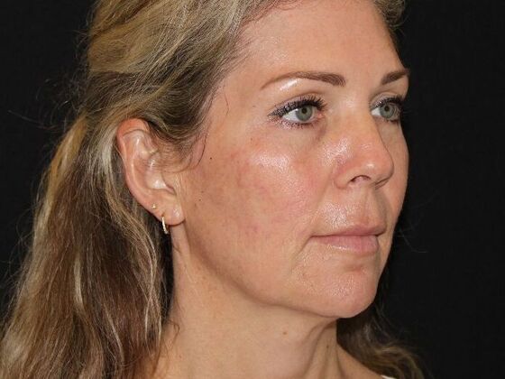 Injectables: Case 91 - Before