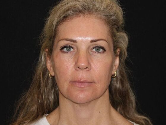 Injectables Case 91 - Before