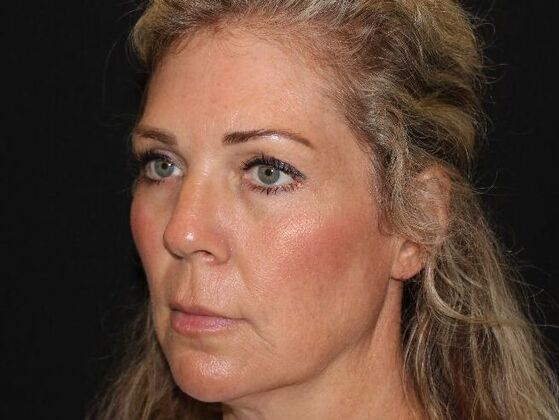 Injectables: Case 91 - After