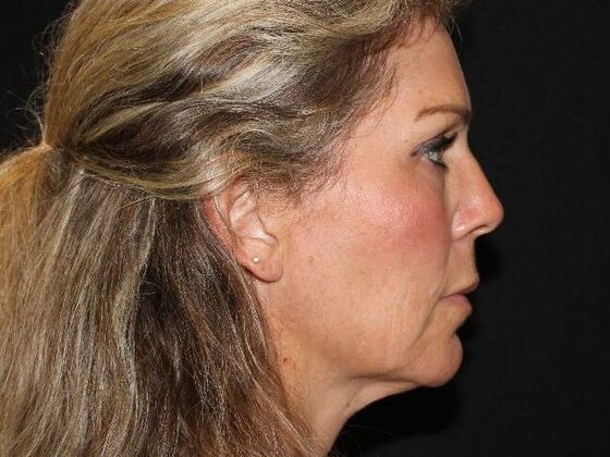 Injectables: Case 91 - After