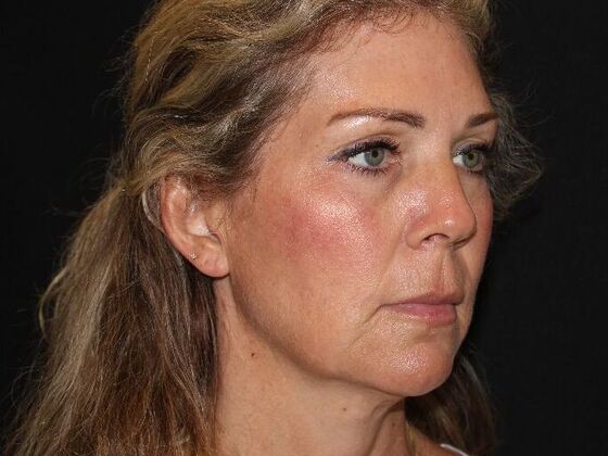 Injectables: Case 91 - After