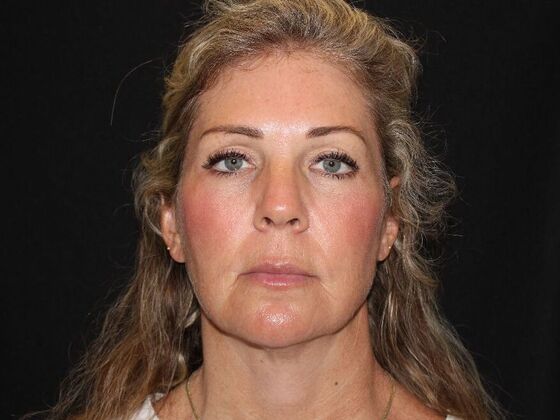 Injectables Case 91 - After