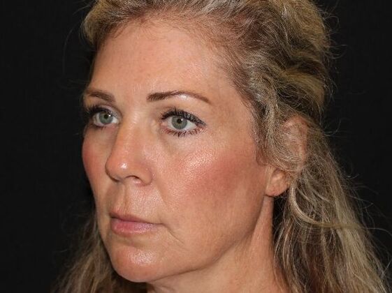 Injectables: Case 91 - After