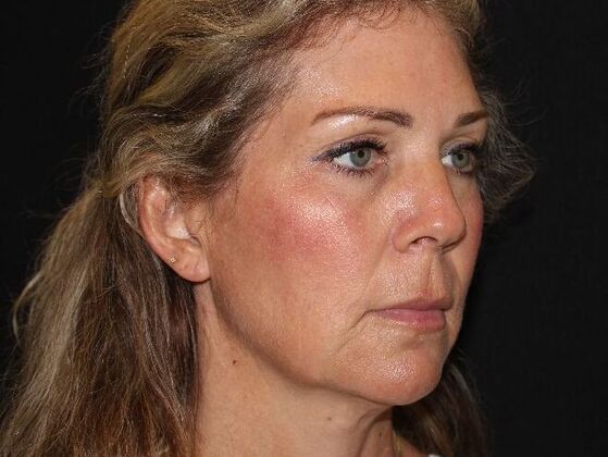 Injectables: Case 91 - After