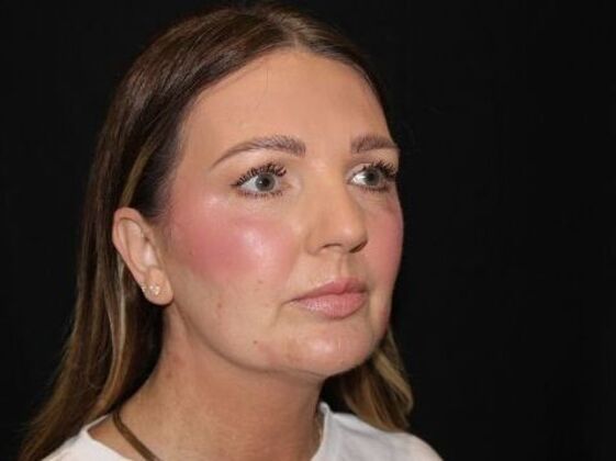 Injectables: Case 92 - Before