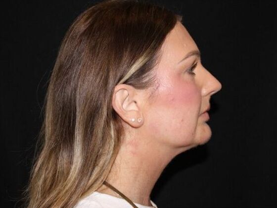 Injectables Case 92 - Before