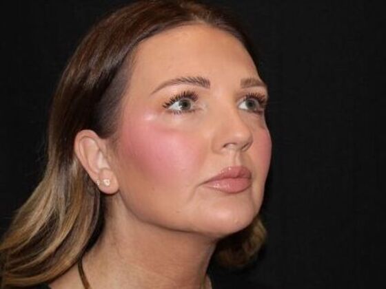 Injectables: Case 92 - After