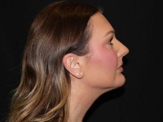 Injectables Case 92 - After