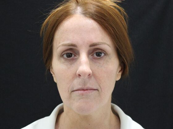 Injectables: Case 93 - Before