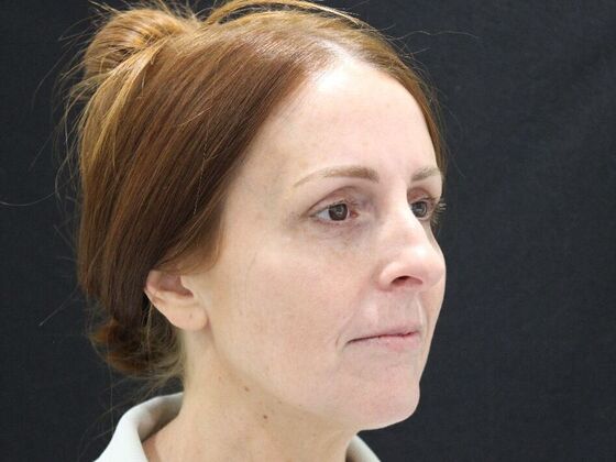 Injectables Case 93 - Before