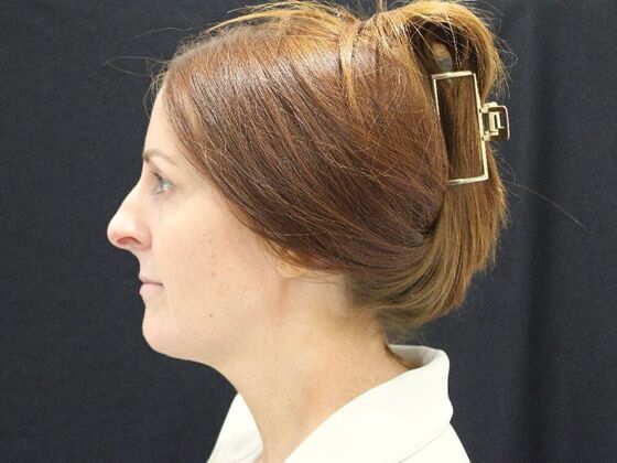 Injectables: Case 93 - Before