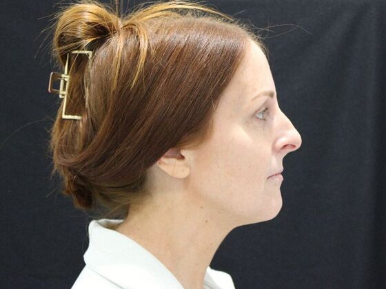 Injectables: Case 93 - Before