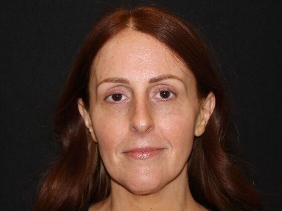 Injectables: Case 93 - After