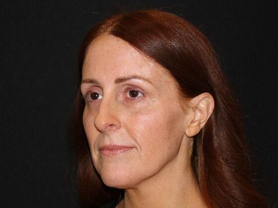 Injectables: Case 93 - After