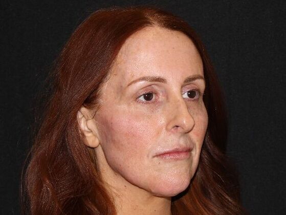 Injectables Case 93 - After