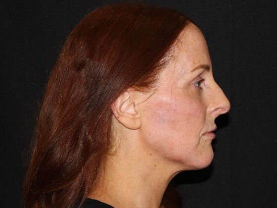 Injectables: Case 93 - After