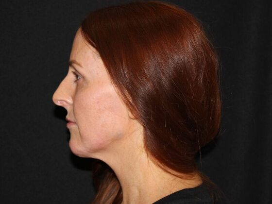 Injectables: Case 93 - After