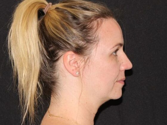 Injectables: Case 94 - Before