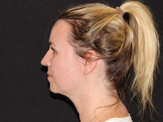 Injectables: Case 94 - Before