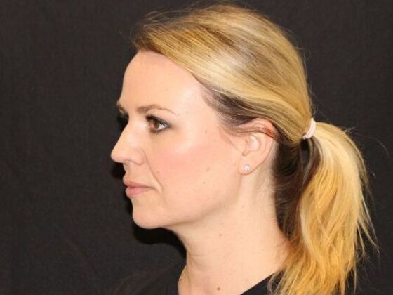 Injectables: Case 94 - After