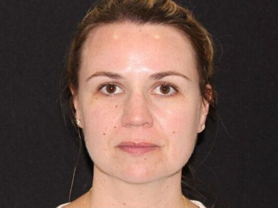 Injectables Case 94 - Before