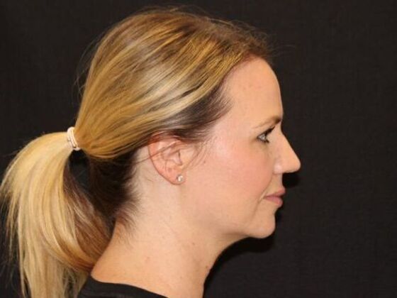 Injectables: Case 94 - After